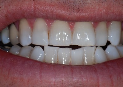 Enlighten Tooth Whitening